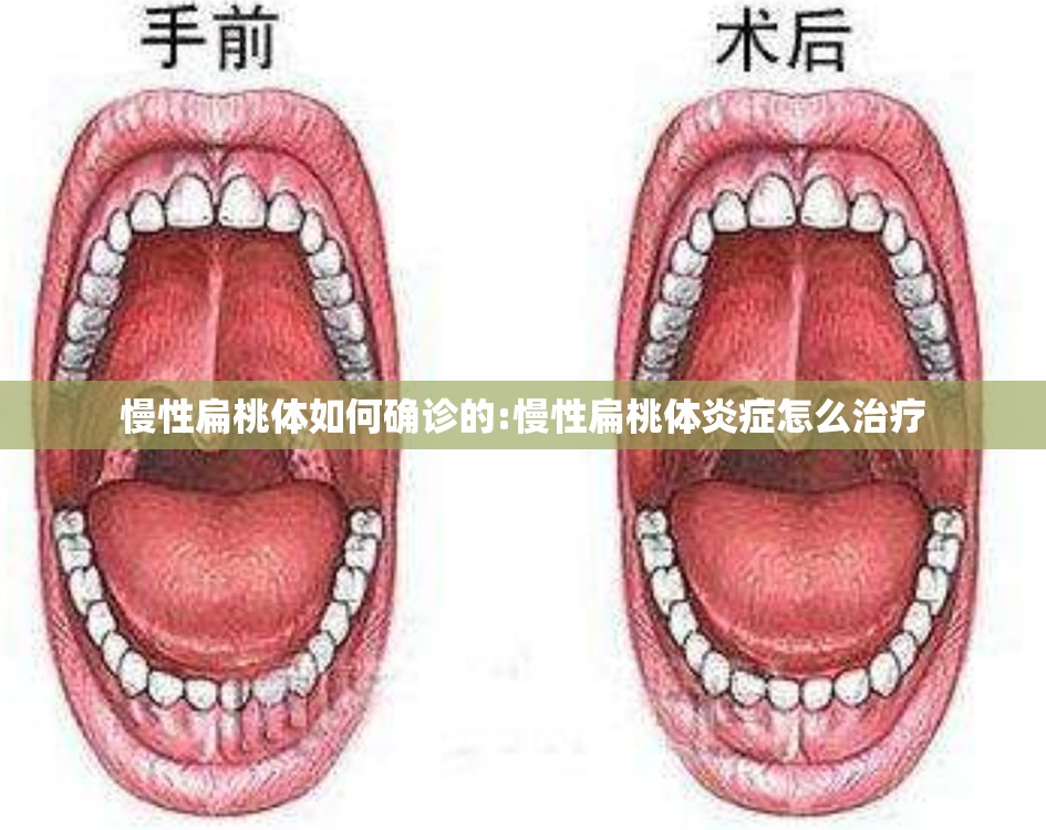 慢性扁桃体如何确诊的:慢性扁桃体炎症怎么治疗 慢性扁桃体如何确诊的:慢性扁桃体炎症怎么治疗