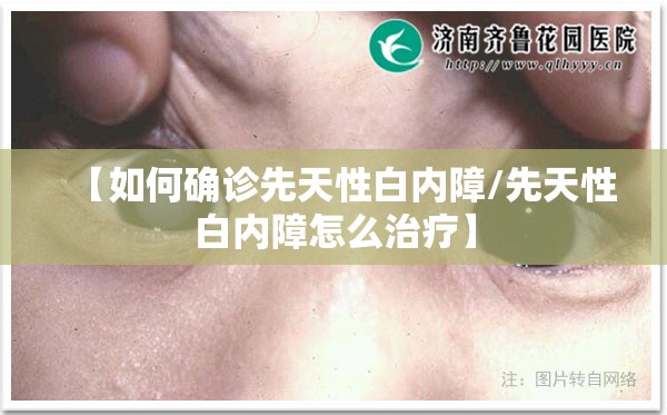 【如何确诊先天性白内障/先天性白内障怎么治疗】