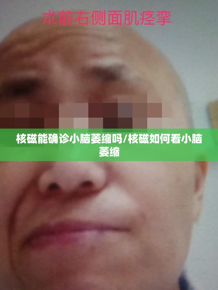 核磁能确诊小脑萎缩吗/核磁如何看小脑萎缩 核磁能确诊小脑萎缩吗/核磁如何看小脑萎缩