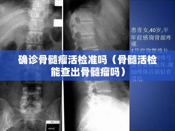 确诊骨髓瘤活检准吗(骨髓活检能查出骨髓瘤吗) 确诊骨髓瘤活检准吗(骨髓活检能查出骨髓瘤吗)