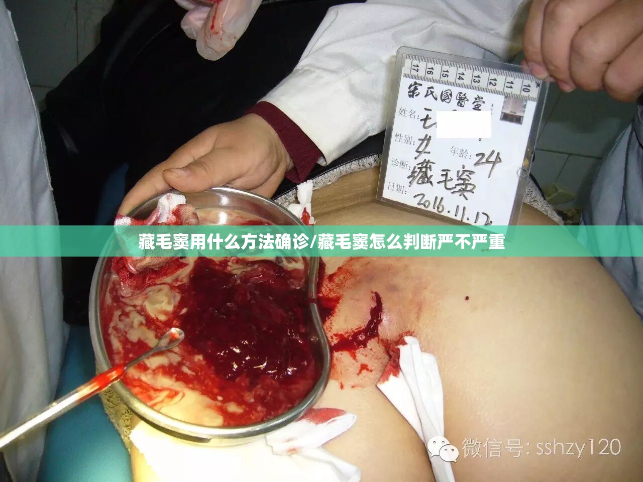 藏毛窦用什么方法确诊/藏毛窦怎么判断严不严重 藏毛窦用什么方法确诊/藏毛窦怎么判断严不严重