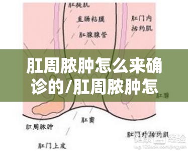 肛周脓肿怎么来确诊的/肛周脓肿怎么确定有没有肛瘘 肛周脓肿怎么来确诊的/肛周脓肿怎么确定有没有肛瘘