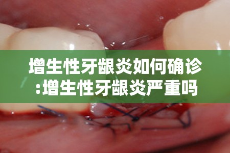 增生性牙龈炎如何确诊:增生性牙龈炎严重吗 增生性牙龈炎如何确诊:增生性牙龈炎严重吗