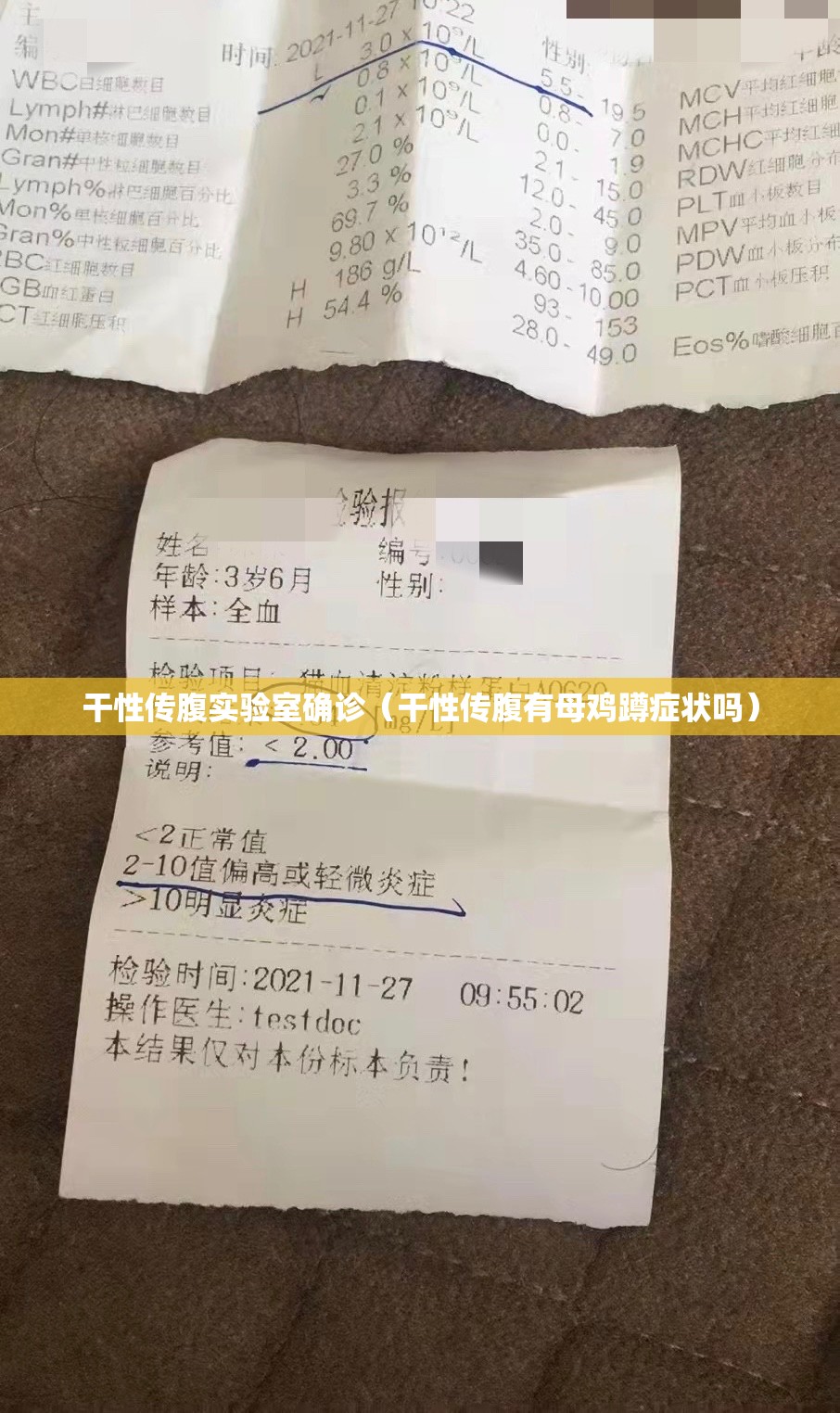干性传腹实验室确诊（干性传腹有母鸡蹲症状吗）